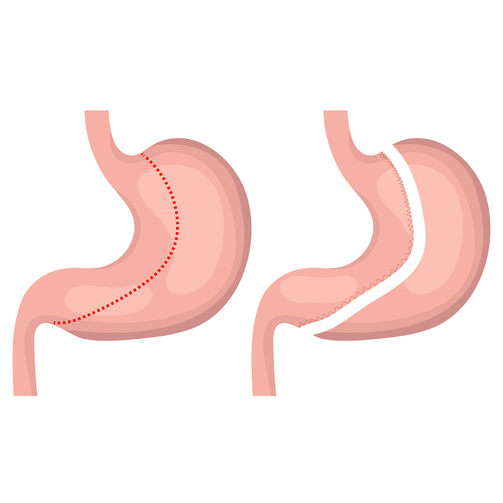 Операція зі зменшення шлунка: кому підходить, як проходить і що очікувати після втручання